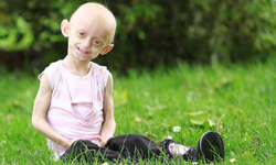 Progeria (Erken yaşlanma) hastalığı nedir? Belirtileri ve tedavisi!