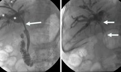 Hibrit yaklaşımla, zorlu safra yolu tedavilerinde yeni dönem başlıyor