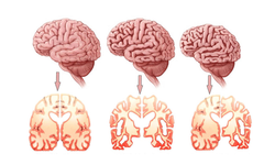 İspanya'da geliştirilen kan testi, alzheimerı erken evrede tespit ediyor