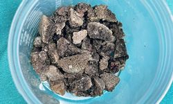 Geyik boynuzu böbrek taşı kapalı yöntemle çıkarıldı