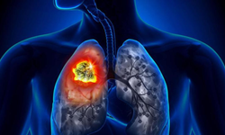 Uzman uyardı: “Bu alışkanlık akciğer kanserinin kapısını açıyor”