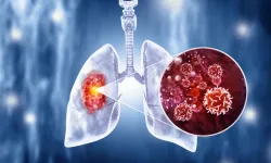 Basit görünen öksürük, Akciğer kanserinin habercisi olabilir