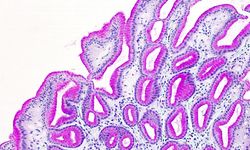 Fibrotest karaciğerde sertlik ve yağlanmayı ölçüyor