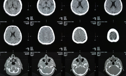 İnmede belirtilere dikkat: 1 dakika bile hayat kurtarır
