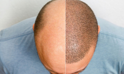 Saç ekimi operasyonu trajik bitti: Hastanede yaşamını kaybetti