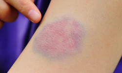 Uzmanlar uyarıyor: Vücutta sık morarma C vitamini eksikliğine işaret edebilir