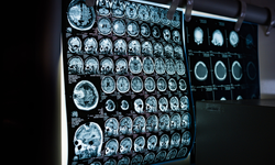 Düşünce gücüyle ilk adım: Felçli kaslar yeniden canlanıyor