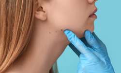 Uzmanı uyardı: Derideki masum görünen benlere dikkat