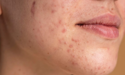 Cilt sorunlarının arkasında hormonlar olabilir