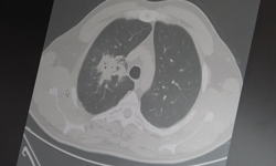 Elektronik sigarada kanser riski bilimsel olarak doğrulandı