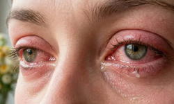 Baharın habercisi alerjiler göz sağlığını tehdit ediyor: Uzmanlardan kritik uyarılar