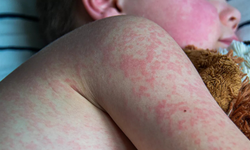 Bangladeş’te kızamık salgını alarmı: 6 haftada 113 çocuk hayatını kaybetti