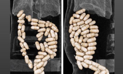 İzmir'de şok olay: Midesinden 1,3 kilo yasaklı madde çıktı