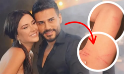 Dilan Polat ve Engin Polat arasında tatil krizi: Darp izlerini paylaşıp sildi