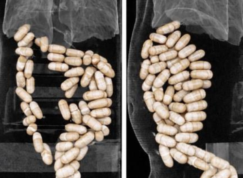 İzmir'de şok olay: Midesinden 1,3 kilo yasaklı madde çıktı