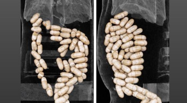 İzmir'de şok olay: Midesinden 1,3 kilo yasaklı madde çıktı