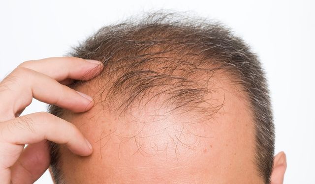 Uzman isim saç dökülmesini hızlandıran alışkanlığı açıkladı