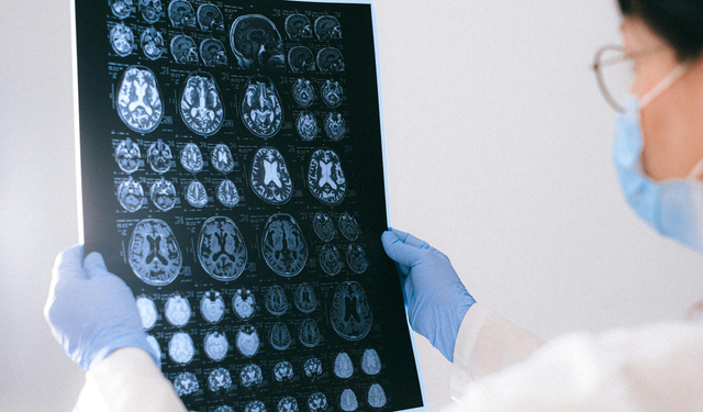 Alzheimer’da çığır açan buluş: Hafıza kaybı tersine çevrilebiliyor