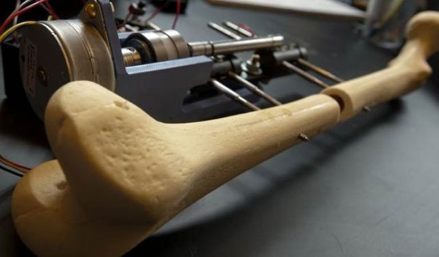 Kemik uzatma hem boy hem deformite sorununa çözüm sunuyor