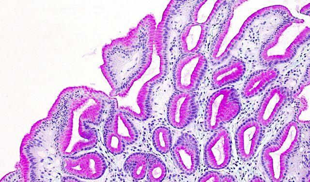 Fibrotest karaciğerde sertlik ve yağlanmayı ölçüyor