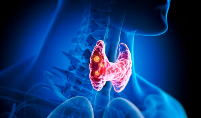 Kilo kaybı ve çarpıntıya dikkat! Zehirli guatrın ilk işaretleri