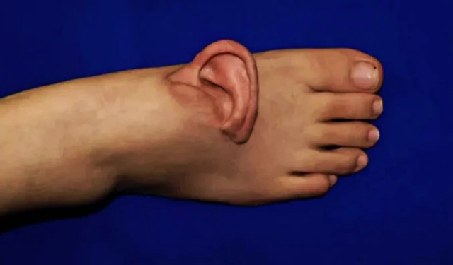 Dünyada bir ilk: Kopan kulak ayakta yaşatıldı,