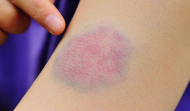 Uzmanlar uyarıyor: Vücutta sık morarma C vitamini eksikliğine işaret edebilir