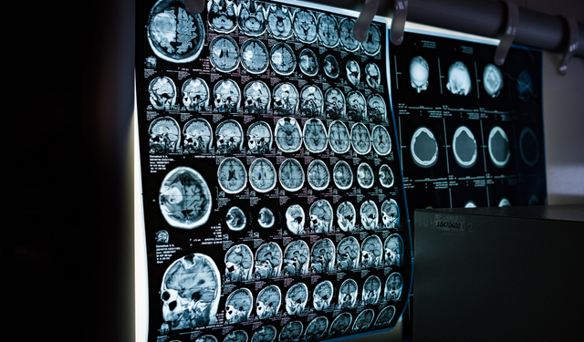 Düşünce gücüyle ilk adım: Felçli kaslar yeniden canlanıyor