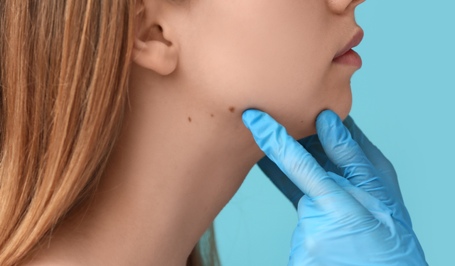 Uzmanı uyardı: Derideki masum görünen benlere dikkat