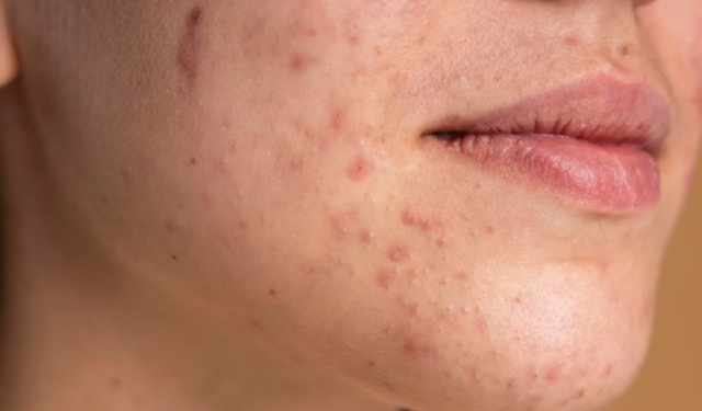 Cilt sorunlarının arkasında hormonlar olabilir