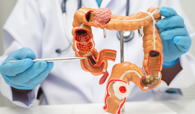 Bağırsaktaki gizli virüs kolon kanseriyle ilişkilendirildi