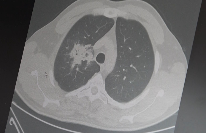 Elektronik sigarada kanser riski bilimsel olarak doğrulandı
