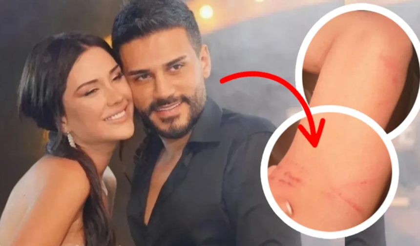 Dilan Polat ve Engin Polat arasında tatil krizi: Darp izlerini paylaşıp sildi