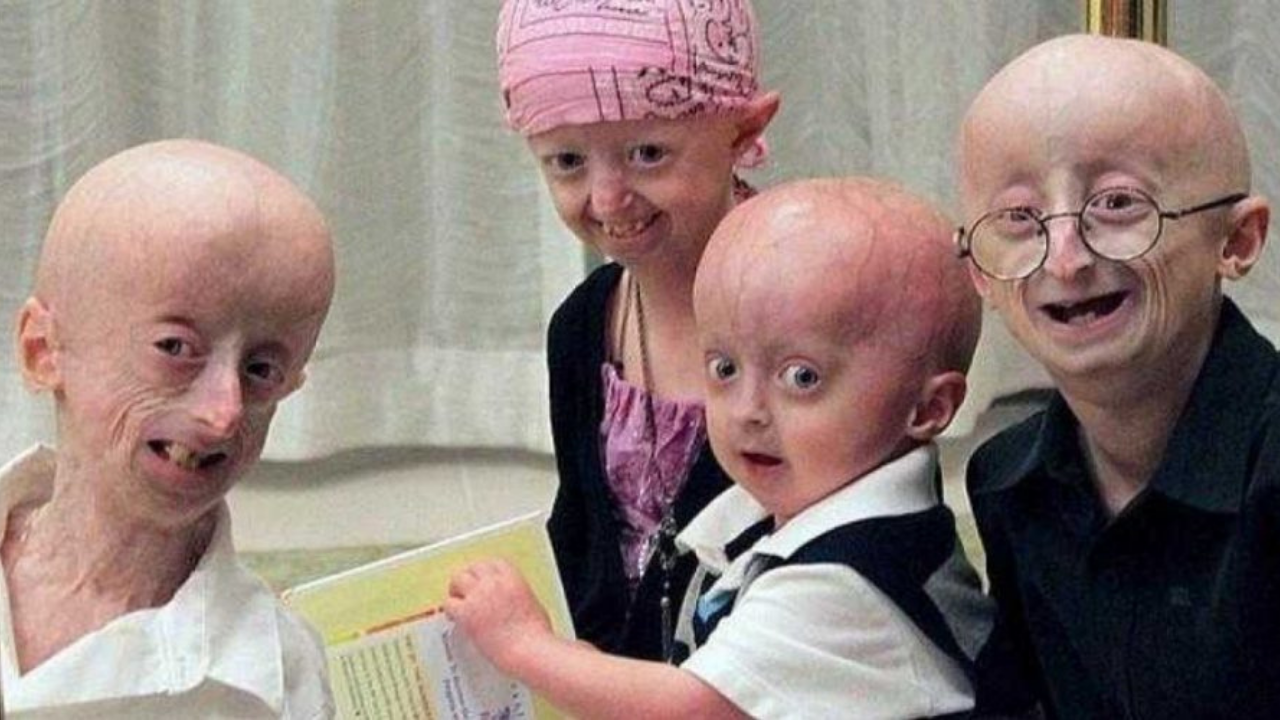 Progeria2