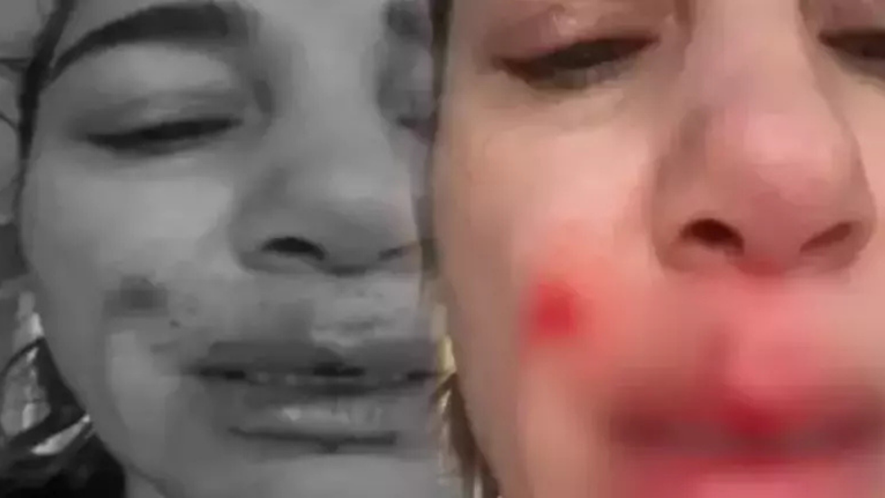 Nadide Sultan Evinde Kaza Geçirdi Dudağına Dikiş Atıldı!