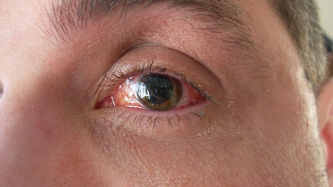 Retina Yırtılması