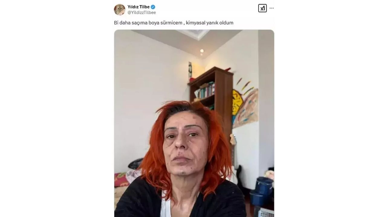 Yıldız Tilbe Yüzünde Oluşan Yanıkların Sebebini Açıkladı! (3)