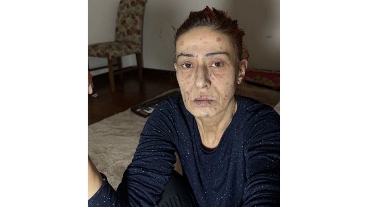 Yıldız Tilbe Yüzünde Oluşan Yanıkların Sebebini Açıkladı! (4)
