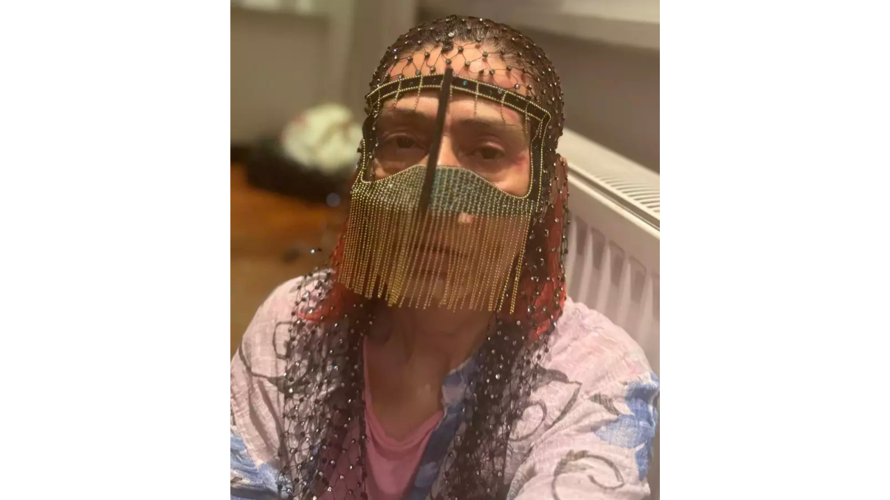 Yıldız Tilbe’den Maskeli Paylaşım Kimyasal Yanık Oldum! (3)