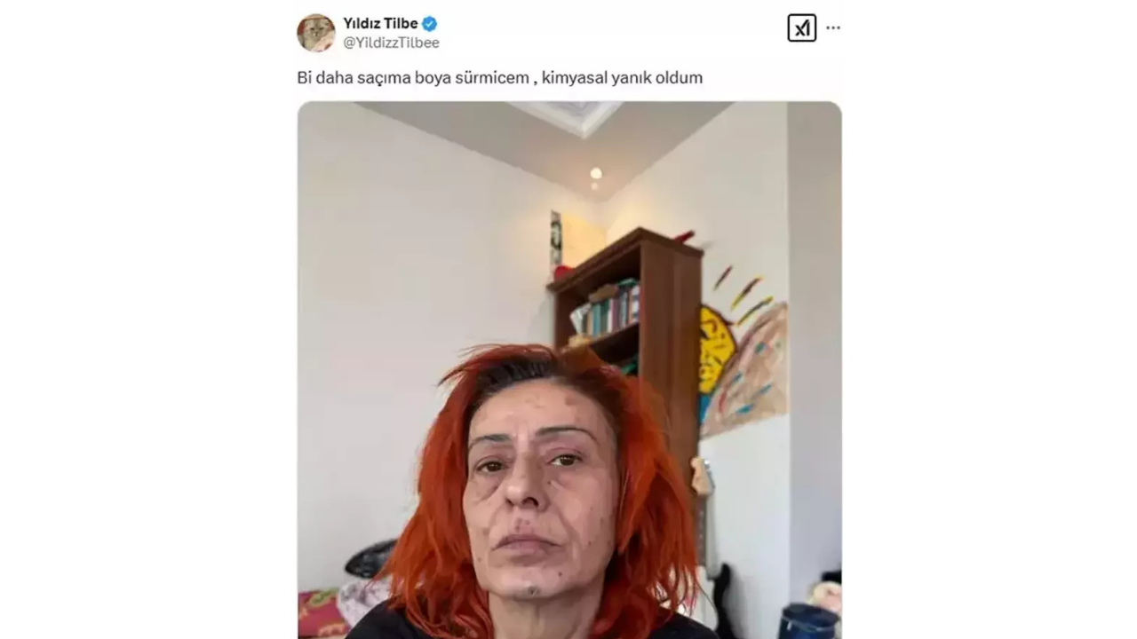 Yıldız Tilbe’den Maskeli Paylaşım Kimyasal Yanık Oldum! (4)