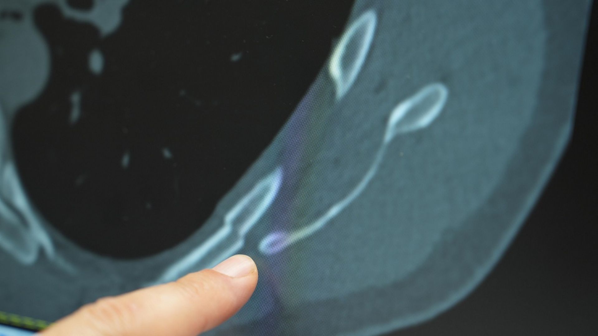 Gençlerde Öksürüğe Bağlı Kaburga Kırıkları Artıyor (1)