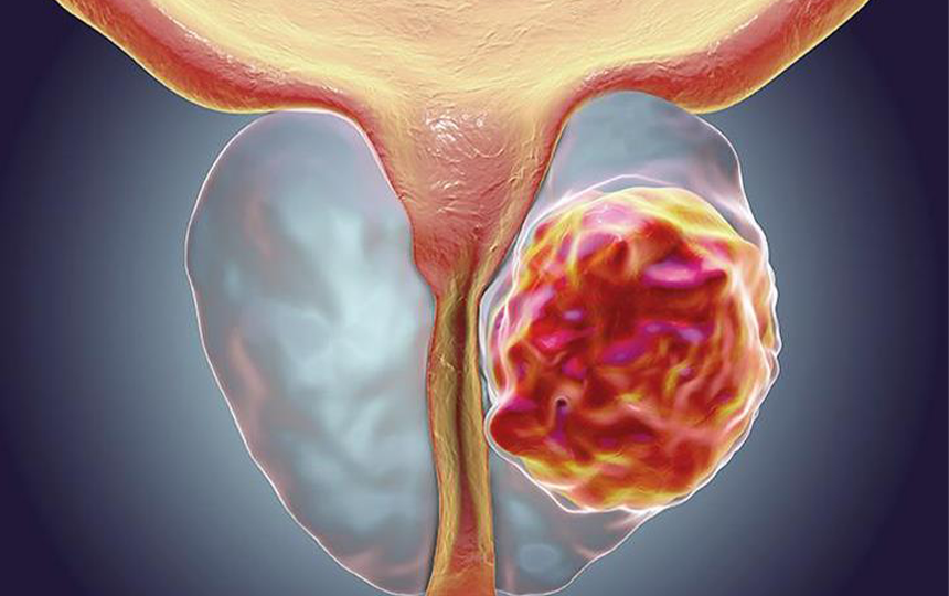 Prostat Kanseri 641Ae7Bf184Af