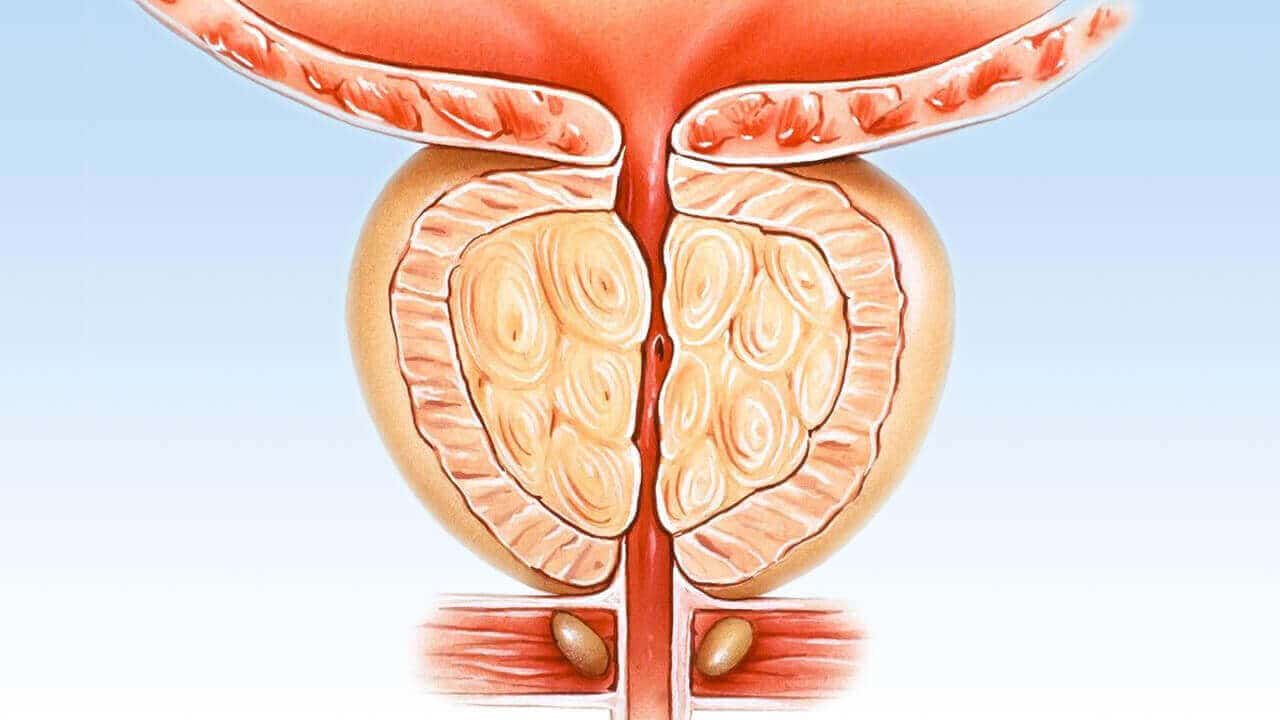 Prostat Tedavisi