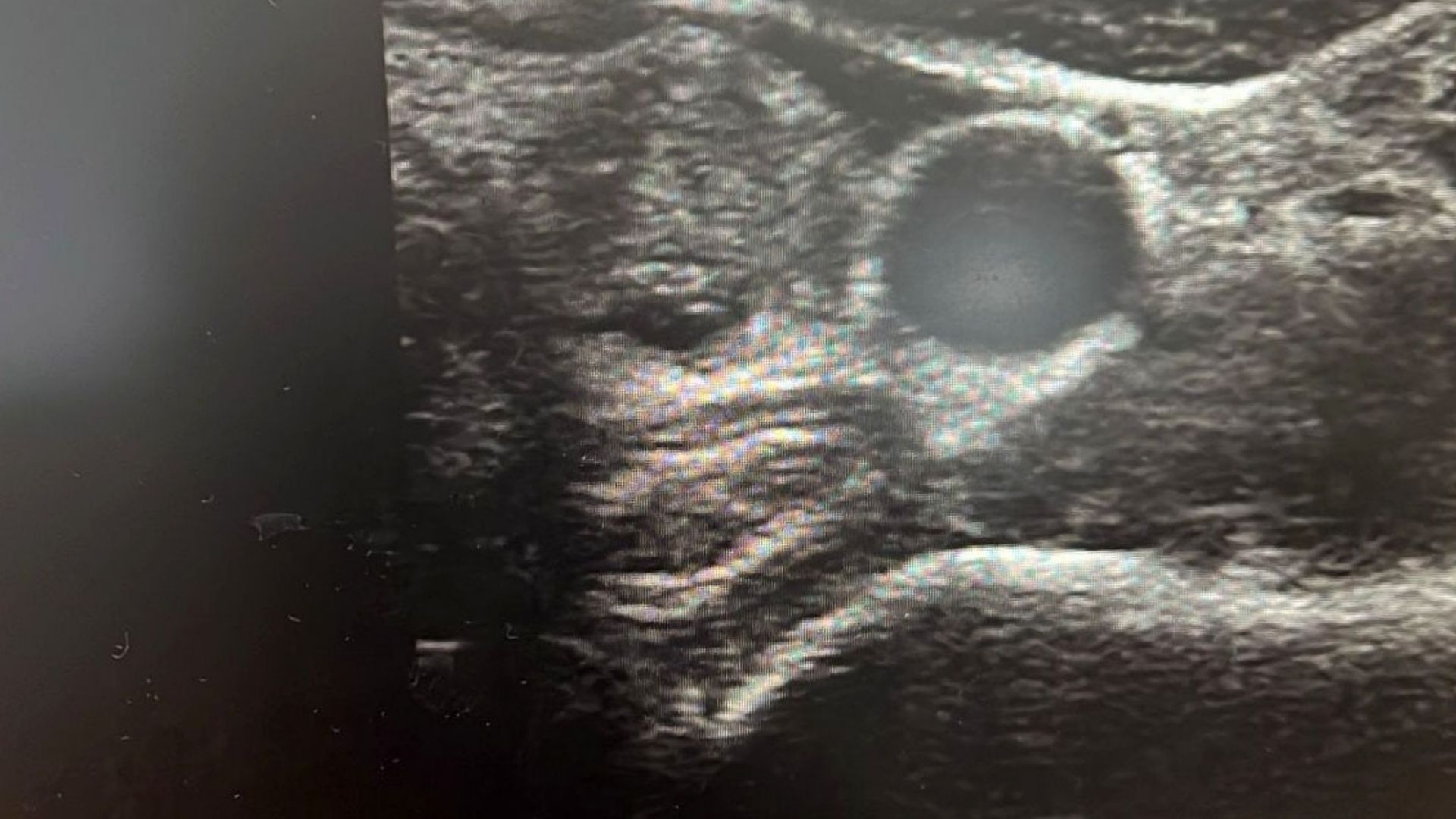 Tiroit Nodüllerinde En Bü.yük Neden İyot Eksiliği (3)