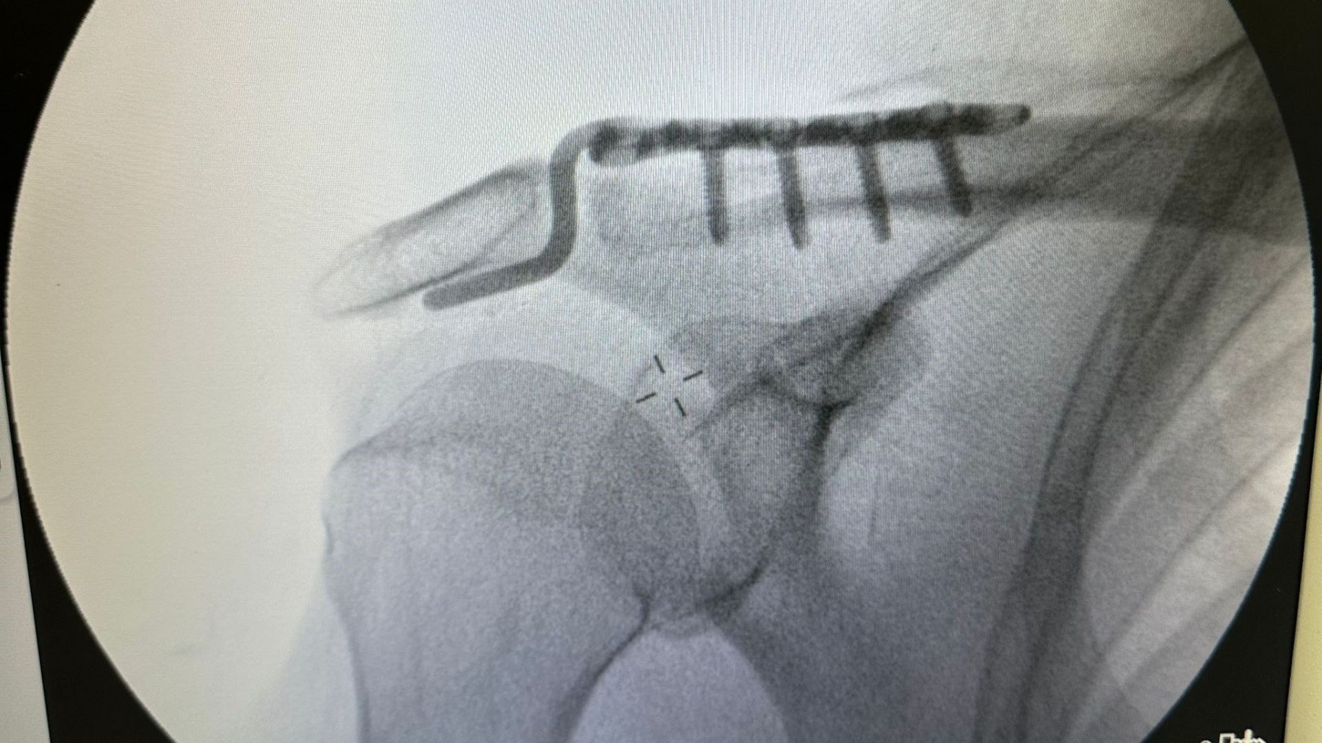 “Ameliyat Olmaz” Denilen 64 Yaşındaki Hasta Özel Plakla Sağlığına Kavuştu (1)