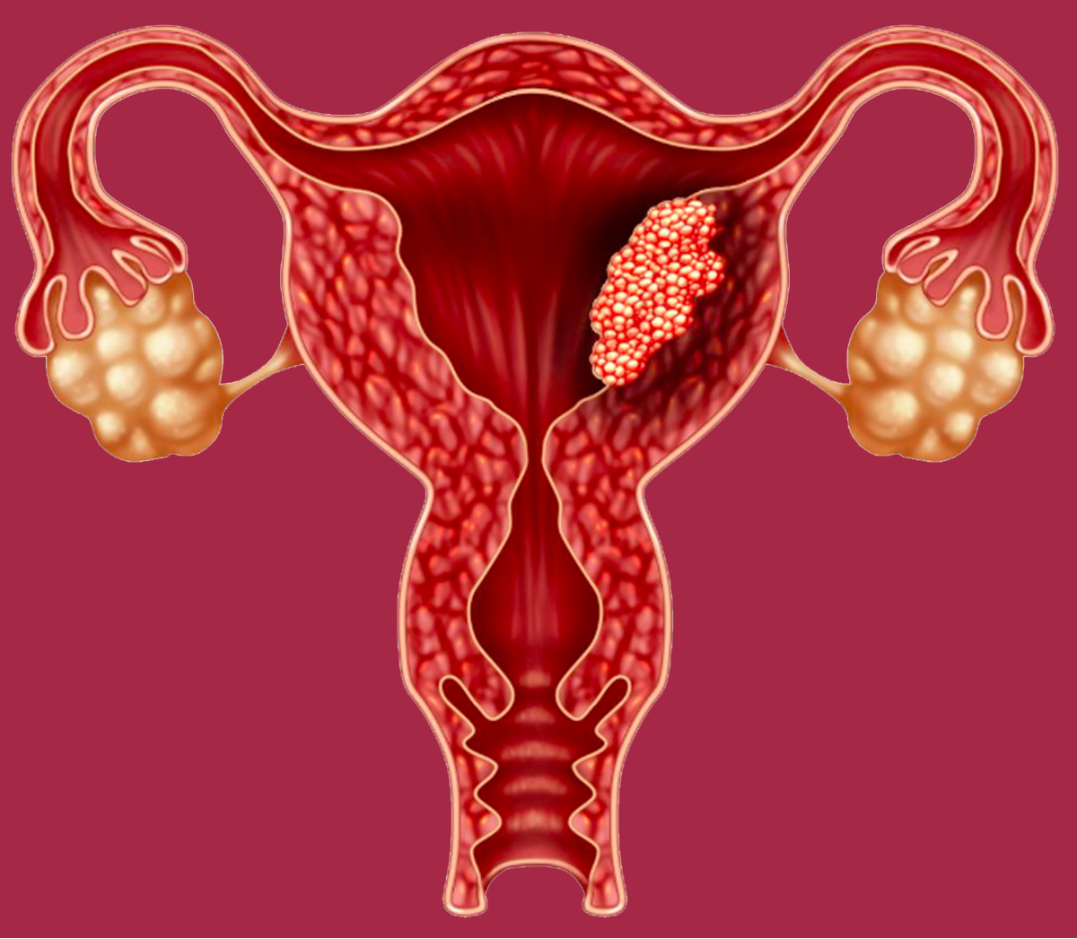 Endometrium Rahim Kanseri Oncusu Endometrial Hiperplaziler Nedir-1