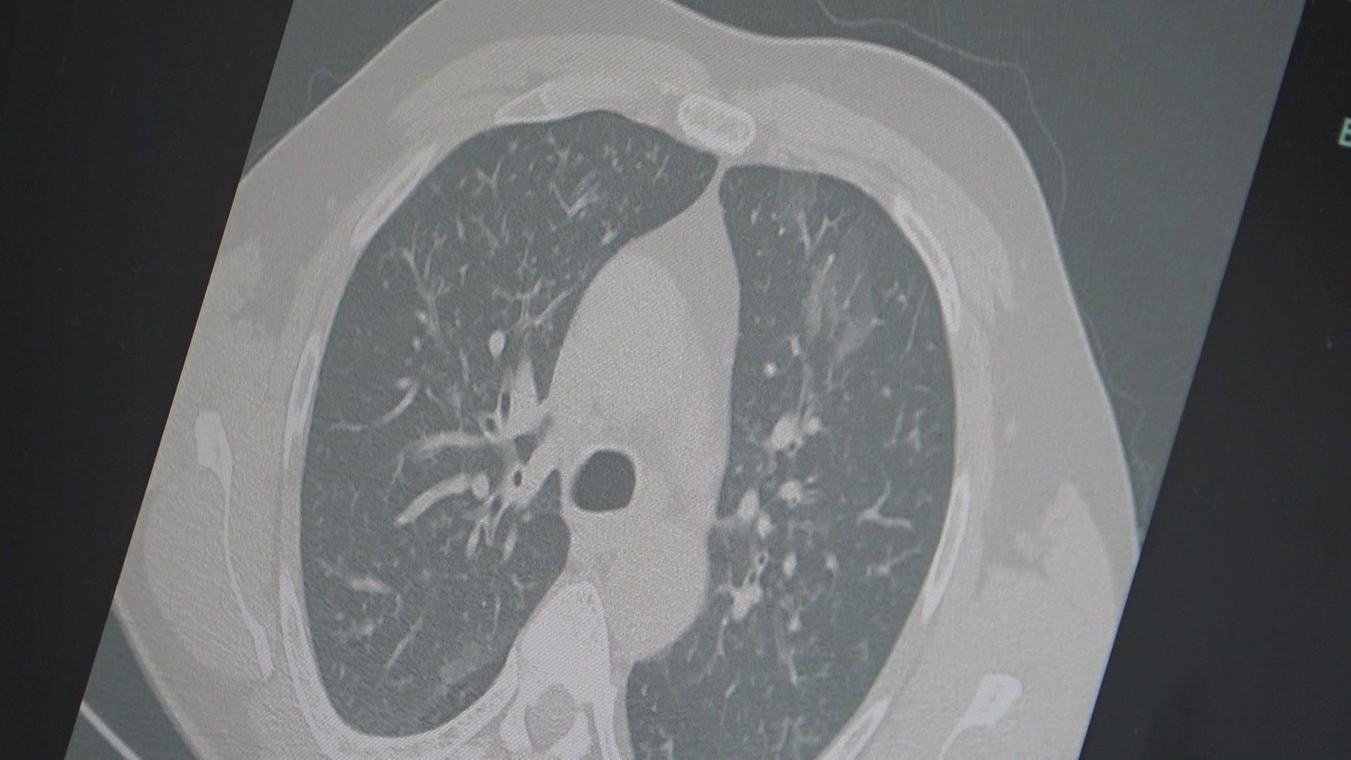 Uzmanlardan Alarm Grip, Kovid Ve Rsv Aynı Anda Yayılıyor (1)