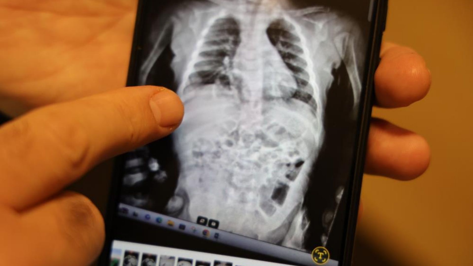 200 Binde Bir Görülen Hastalığı Atlattı 2 Yaşındaki Aram Sağlığına Kavuştu (1)