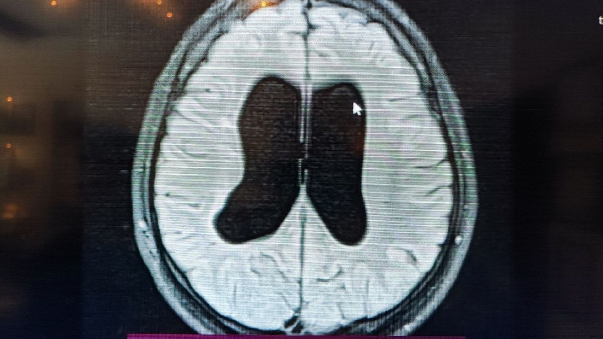 Ameliyat Olmazsa Ölür Denilen Bebek, Doğru Teşhisle Hayata Tutundu (1)