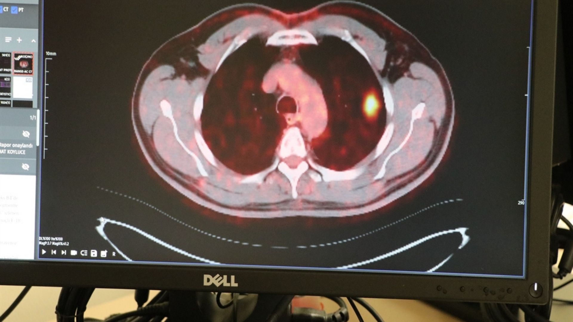 50 Yıllık Tiryaki Kanseri Yendi Sigarayı 2 Aydır Adını Anmadan Bıraktım (1)
